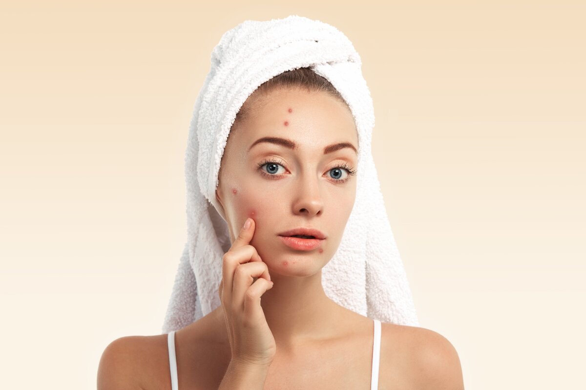 Benarkah Kulit Berjerawat Tidak Boleh Memakai Sunscreen? Simak Penjelasannya Berikut Ini