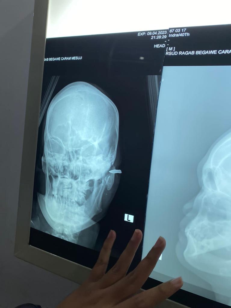Aksi Penganiayaan di Mesuji, Korban Alami Luka Berat