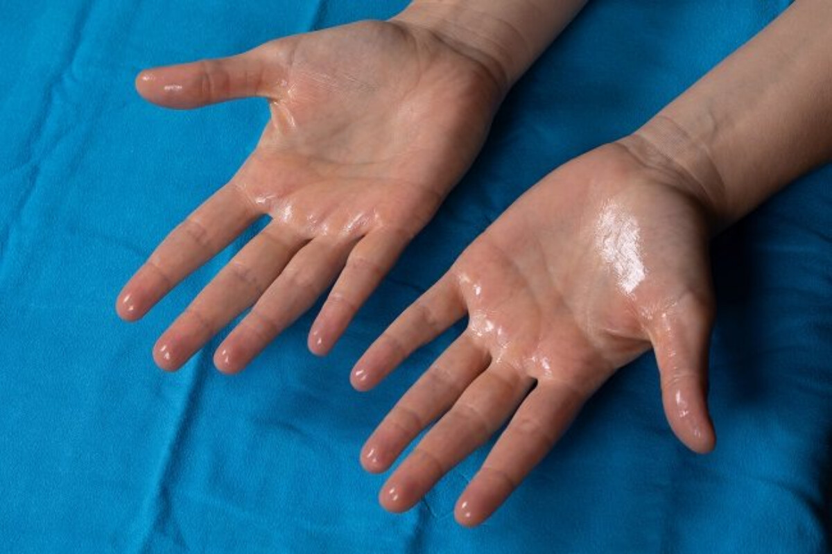 Cara Mengatasi Hiperhidrosis, Kondisi Keringat Berlebih yang Bisa Mengganggu Kesehatan Anda
