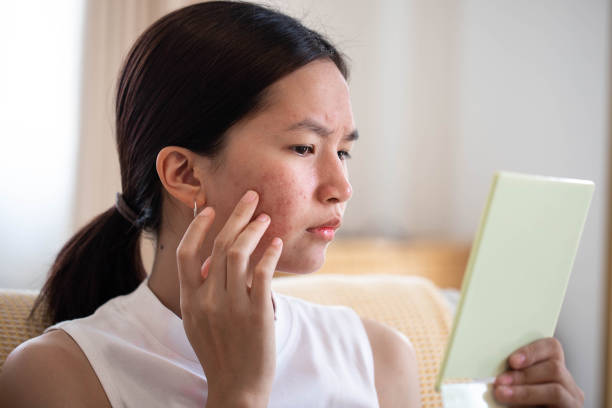 Ini Alasan Jerawat Tambah Banyak Saat Pakai Sunscreen