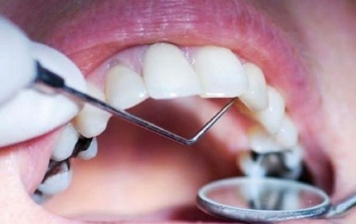 Gigi Berlubang Terasa Sakit? Catat 7 Obat Alami Ini Bisa Atasi Dan Redakan Nyeri