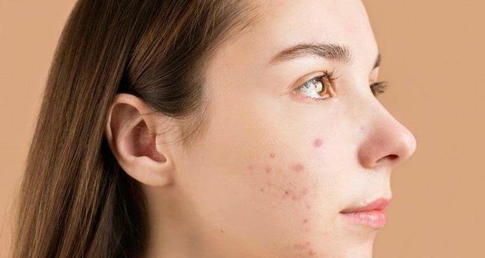 Glowing Cepat, Singkirkan Flek Hitam Wajah Pakai Lulur Susu Kunyit, Ini Rahasianya