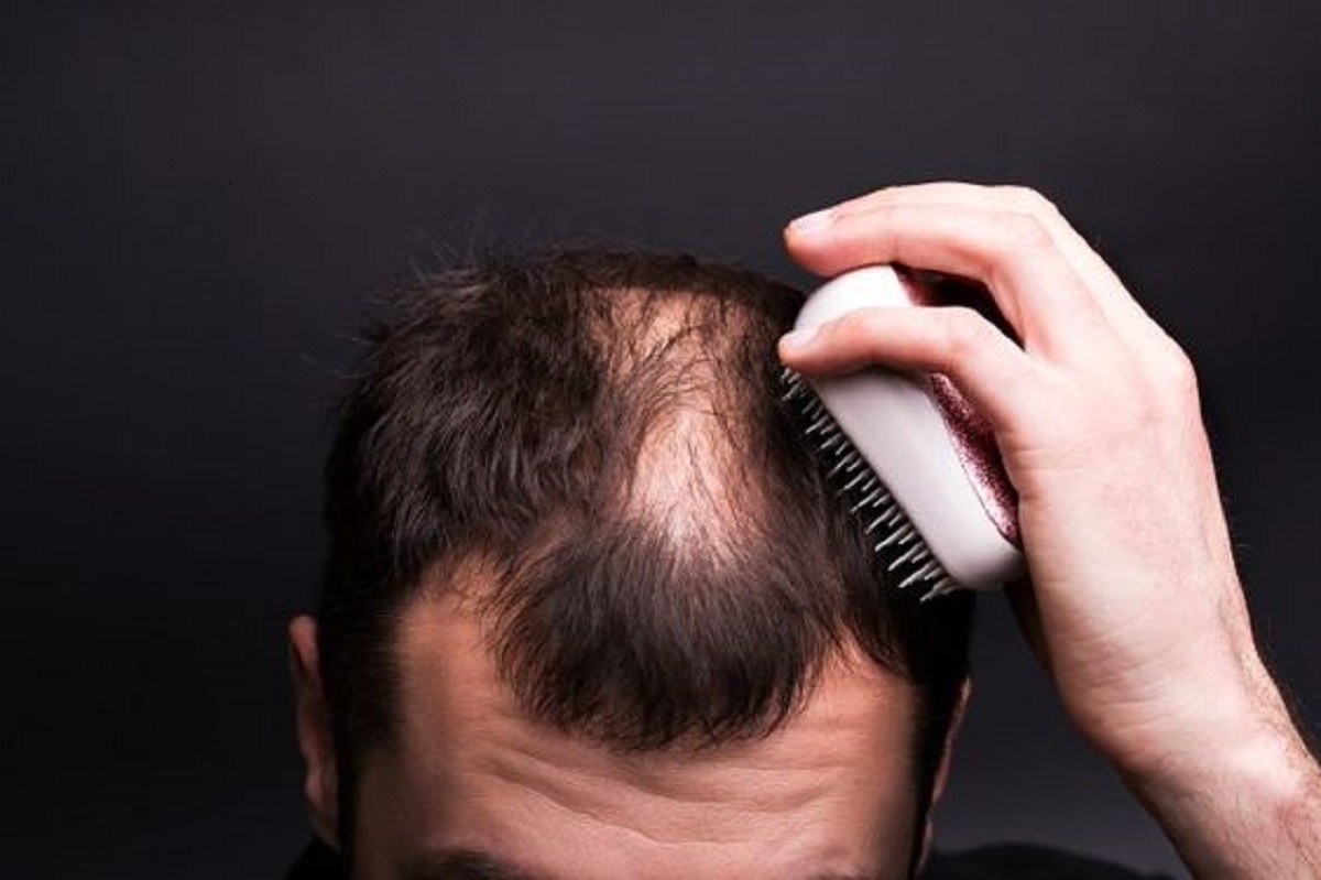 Rambut Rontok Dan Kebotakan Menghampiri? Ini Dia 7 Cara Ampuh Untuk Mengatasinya
