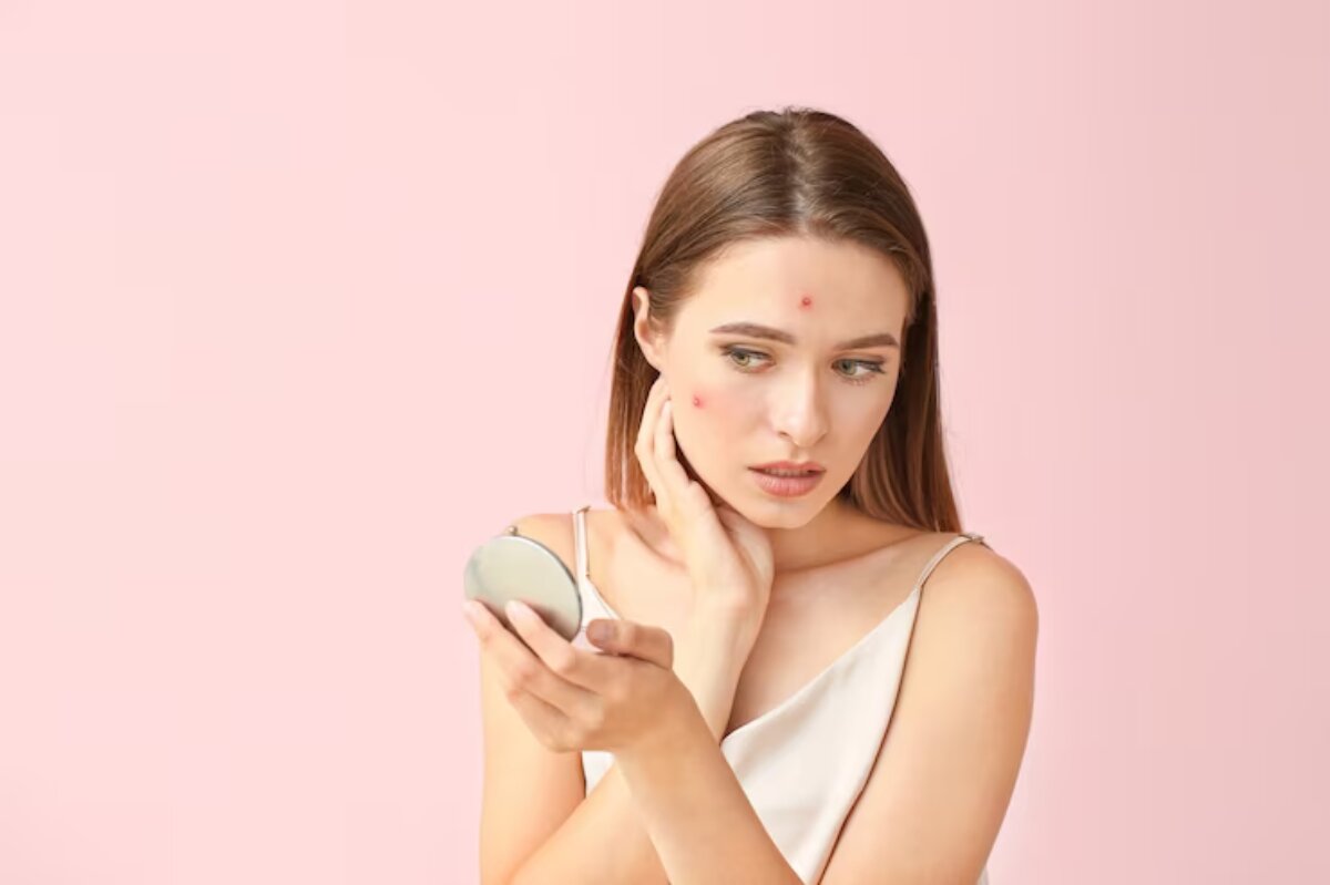 Hayo Jangan Self Diagnosis, Cari Tahu Dulu Jerawat Kalian Termasuk Dalam Kategori Apa