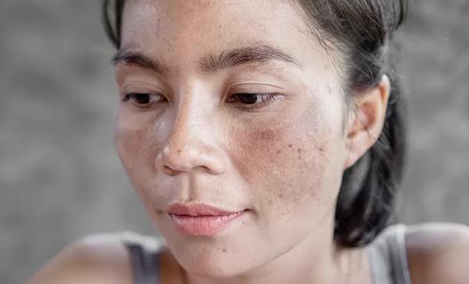 Cara Atasi Flek Hitam Di Pipi Sekaligus Bikin Wajah Kenyal