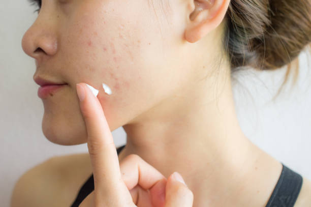 Jangan Bingung! Ini Tips Memilih Sunscreen Untuk Kulit Berjerawat