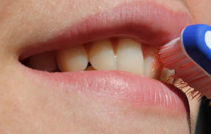 Sering Muncul Bercak Putih Pada Gusi? Awas Bisa Jadi Tanda Leukoplakia
