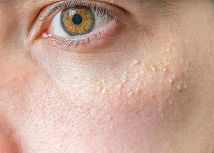 Get to Know Xanthoma: Causes and Treatment