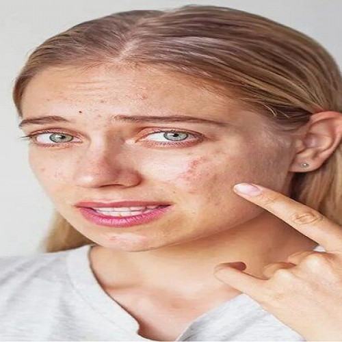 Sangat Ampuh! Cara Menghilangkan Jerawat dengan Cepat Tanpa Bekas
