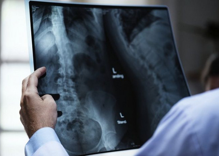 Cegah Risiko Osteoporosis dengan Langkah Berikut