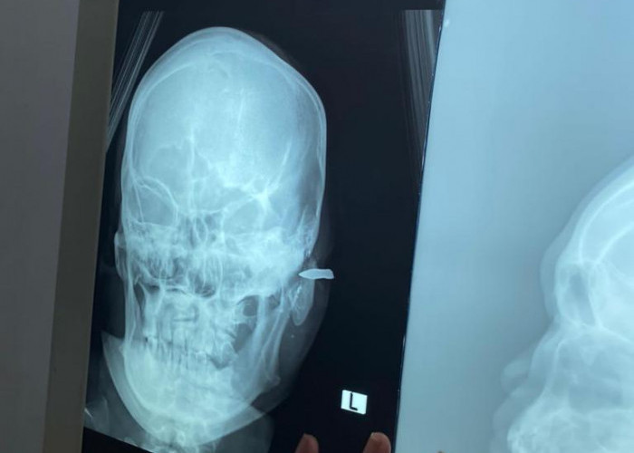 Aksi Penganiayaan di Mesuji, Korban Alami Luka Berat