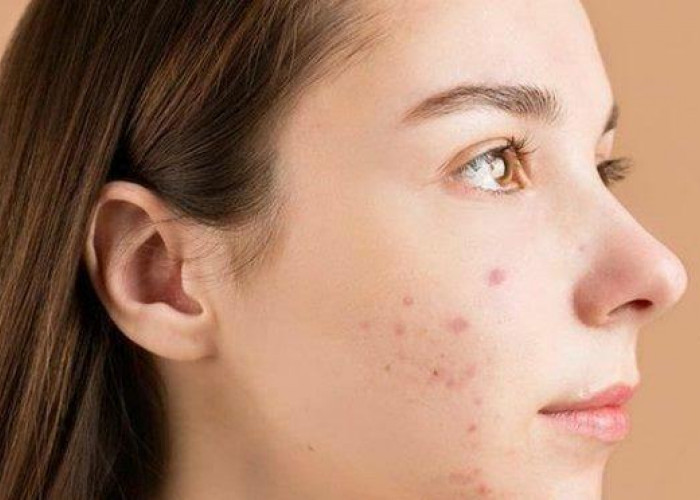 Glowing Cepat, Singkirkan Flek Hitam Wajah Pakai Lulur Susu Kunyit, Ini Rahasianya