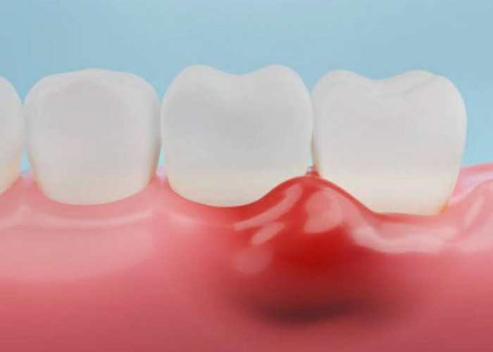 Awas, Nyeri Gusi Setelah Makan Daging Bisa Sebabkan Gingivitis