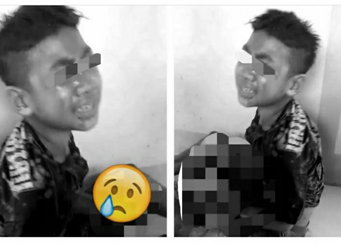 Tangan Bocah Hancur Disebut karena Tersambar Petir Saat Main HP, Ternyata Kena Ledakan Petasan