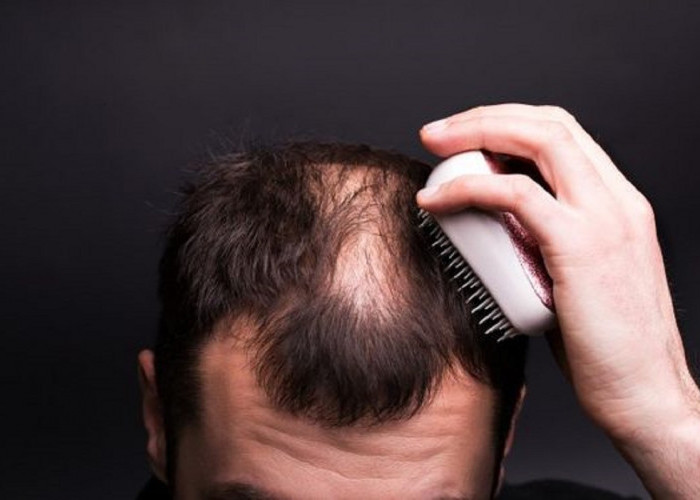 Rambut Rontok Dan Kebotakan Menghampiri? Ini Dia 7 Cara Ampuh Untuk Mengatasinya