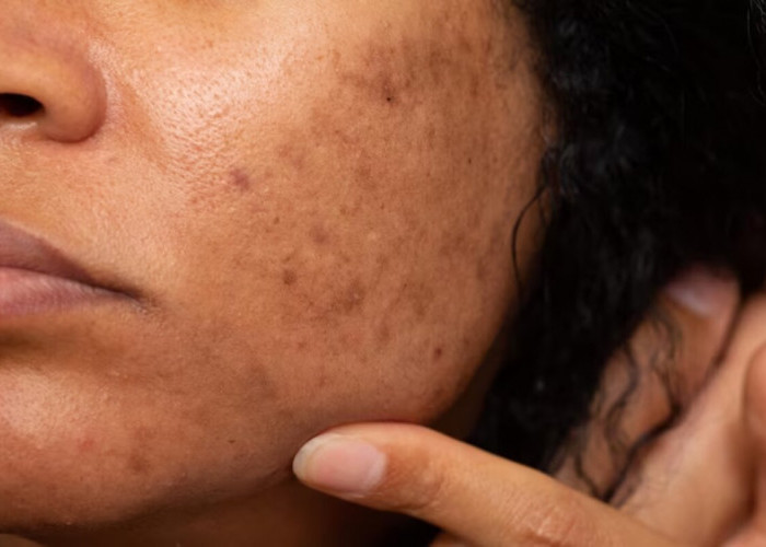 5 Cara Ampuh Menghilangkan Bekas Jerawat Menghitam
