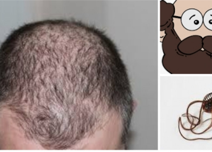 Enam Cara Mengatasi Kerontokan Rambut dengan Bahan Alami